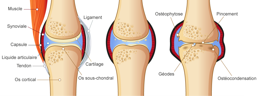 Représentation de l'évolution dans le temps d'une articulation arthrosique.
