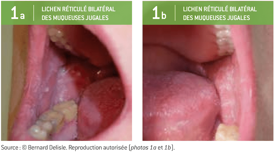 lichen plan oral images du Dr Bernard Delisle 